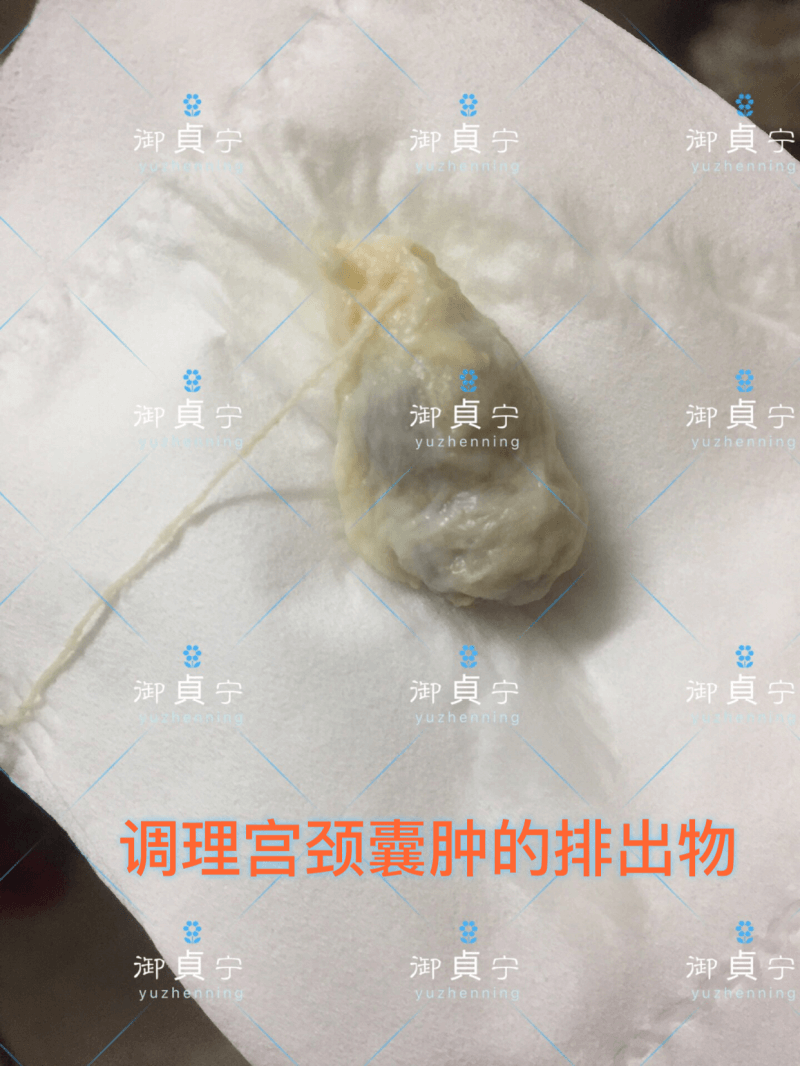 调理宫颈囊肿排出物反馈