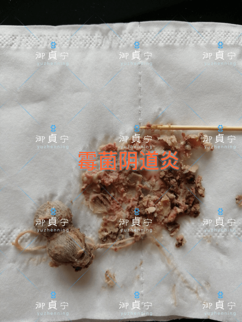调理霉菌性阴道炎反馈