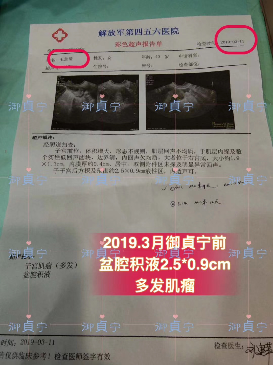 HPV43转阴、2.5cm盆腔积液康复