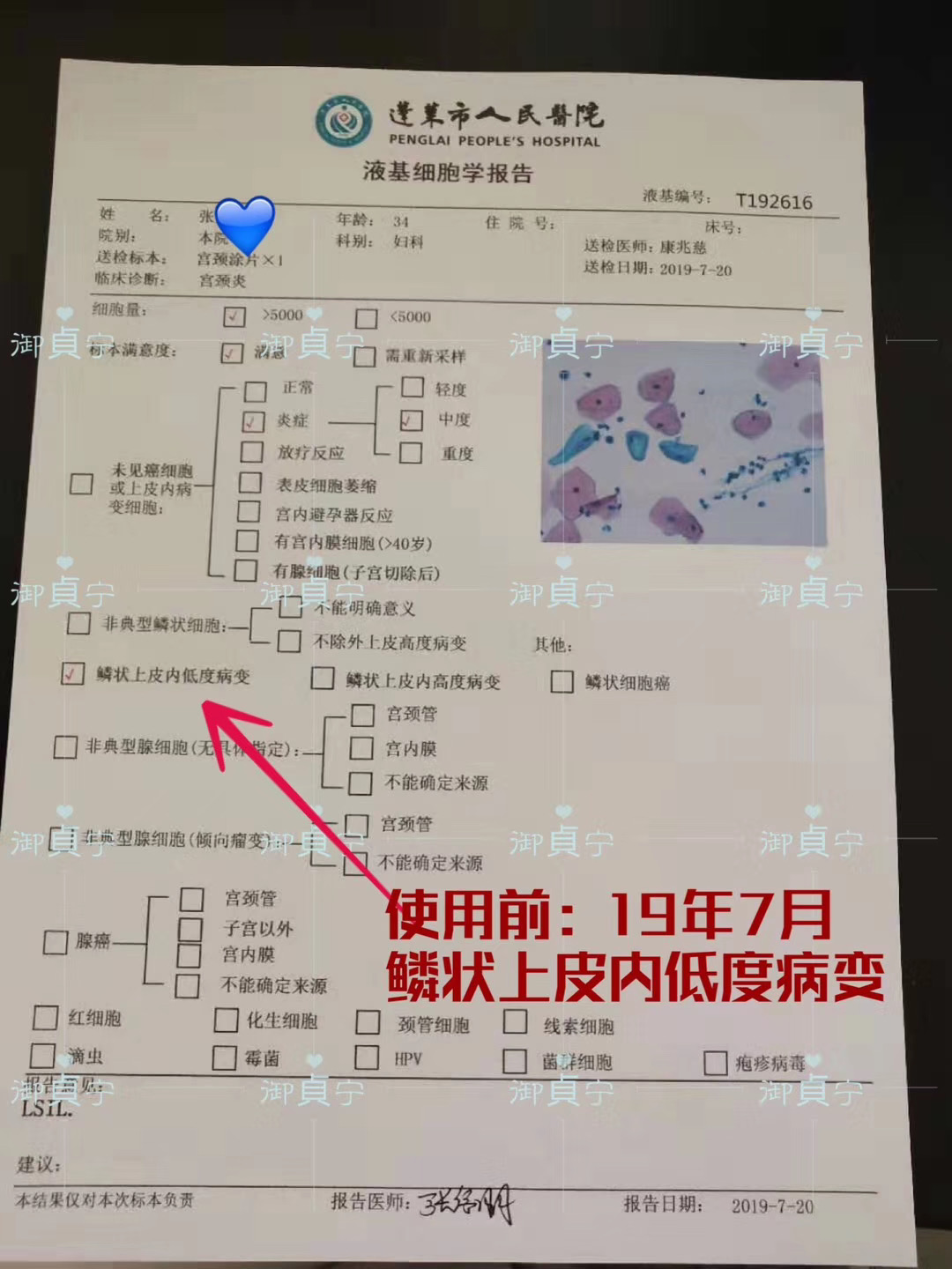 HPV51，HPV43转阴
