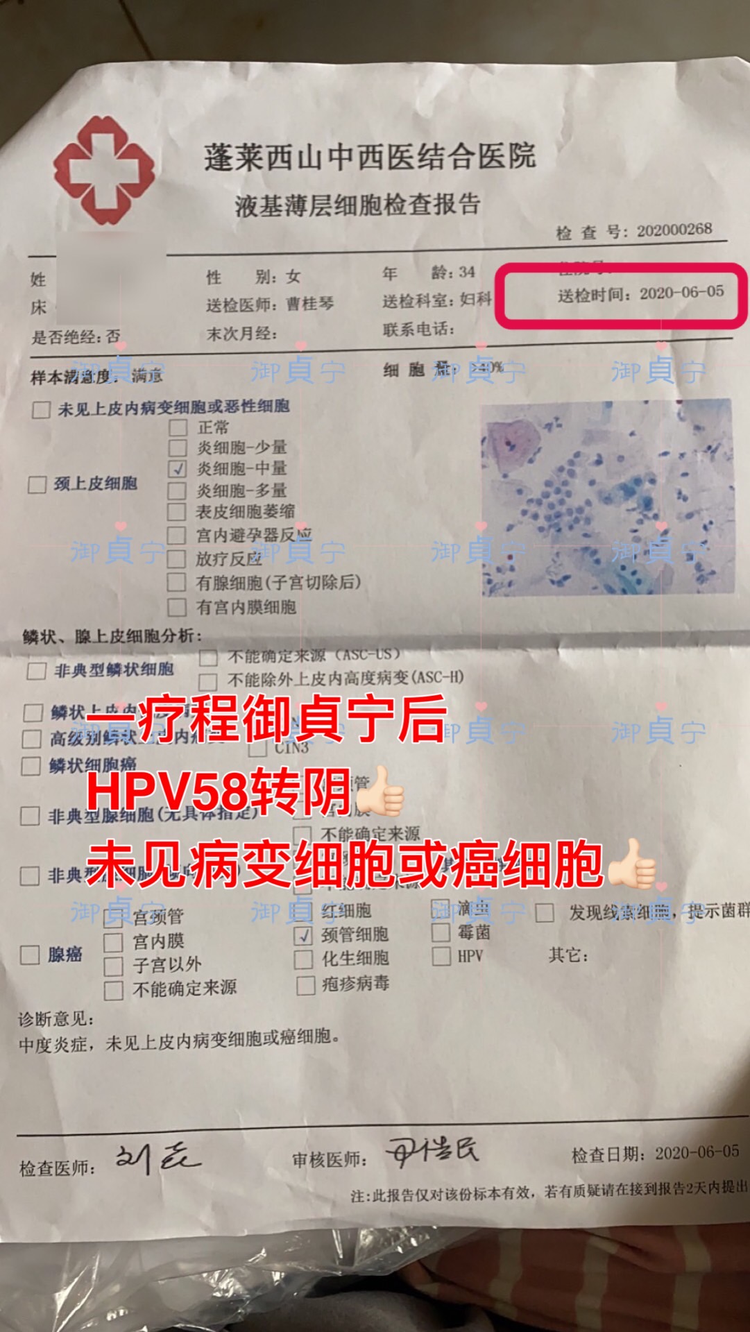   HPV58转阴的排出物
