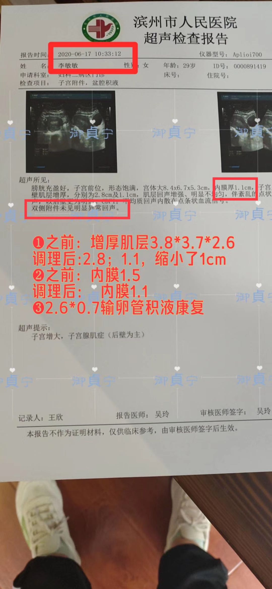 李敏妹妹实名制反馈/增厚肌层3.8*3.7*2.6/内膜1.5/2.6*0.7输卵管
