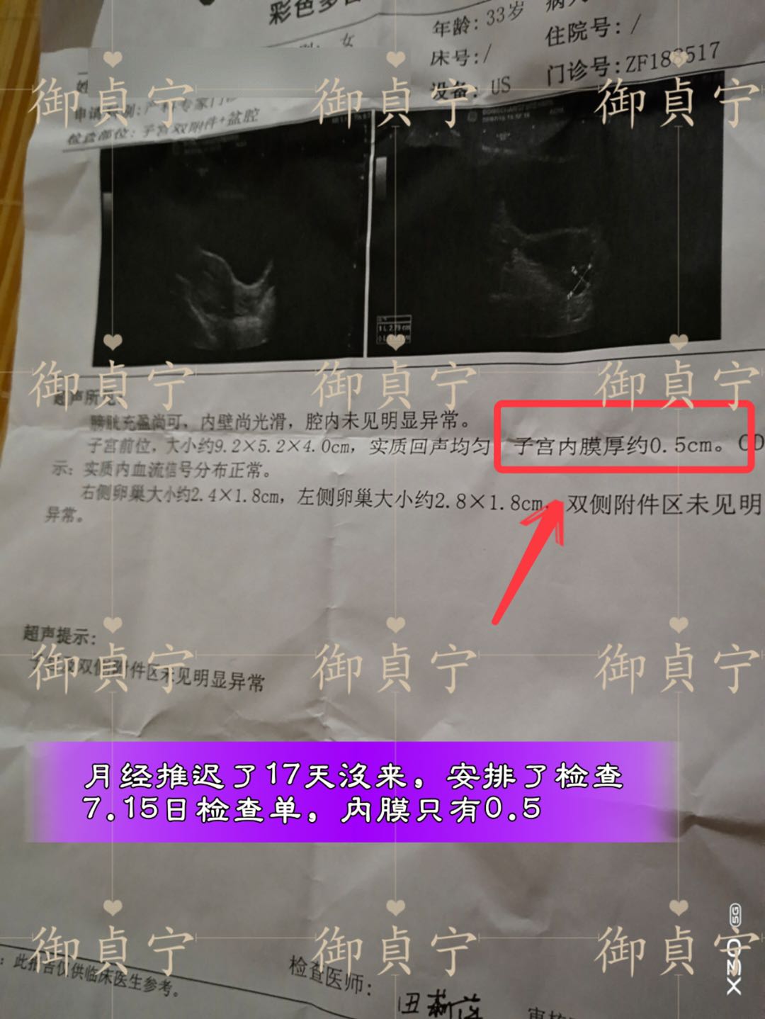 御貞宁·调经； 一粒就来了  7月15号检查单内膜也只有0.5cm，7