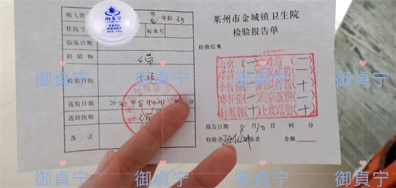 御貞宁2疗程后白带检查非常健康，盆腔积液也康复了
