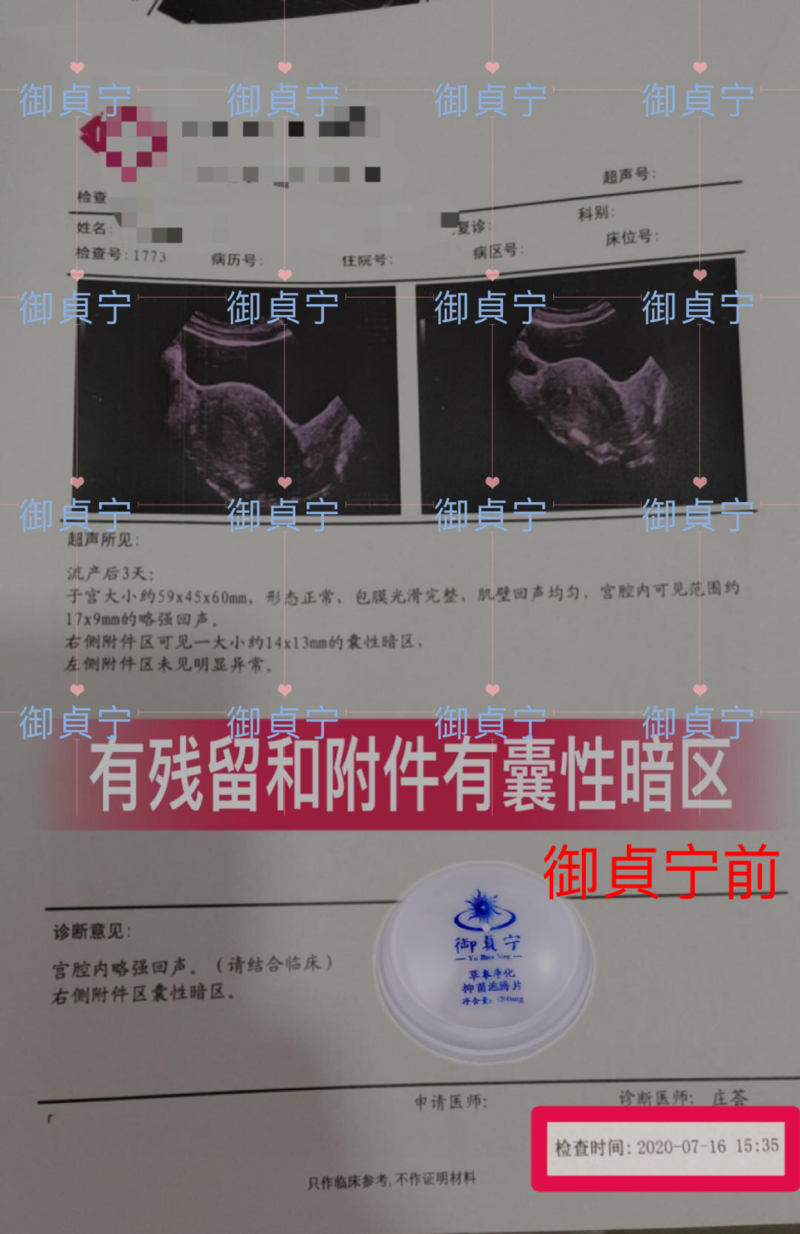 御貞宁排1.7cm的流产残留成功案例  顺便把1.4cm的囊性暗区