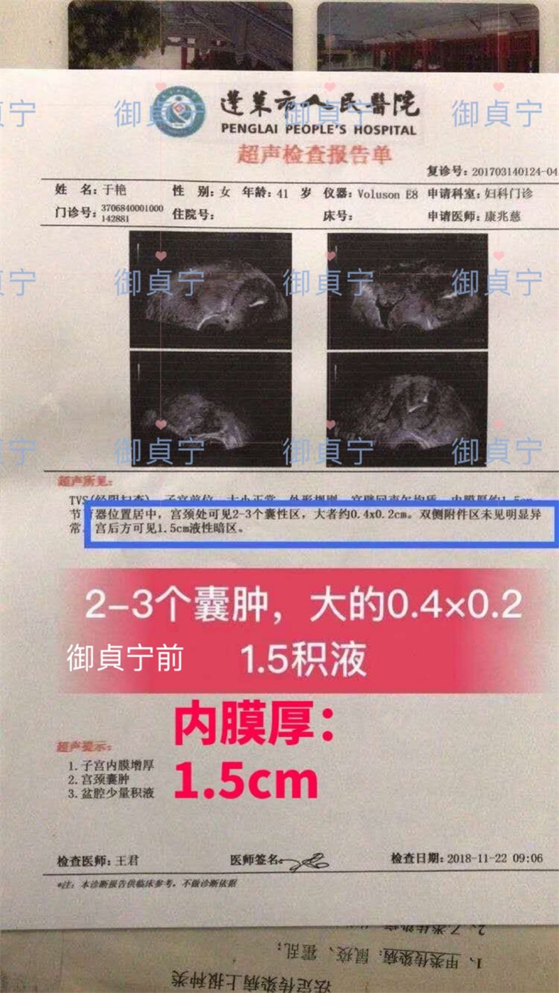 于艳姐实名制反馈,①宫颈囊肿2-3个②盆腔积液内③膜厚：1.5c