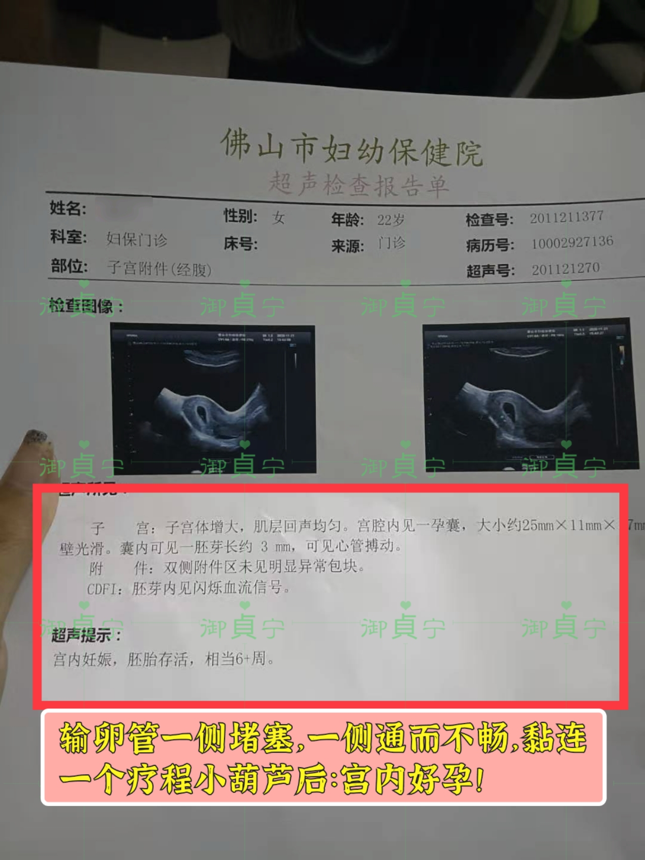 【输卵管堵塞】顾客的宫内好孕
