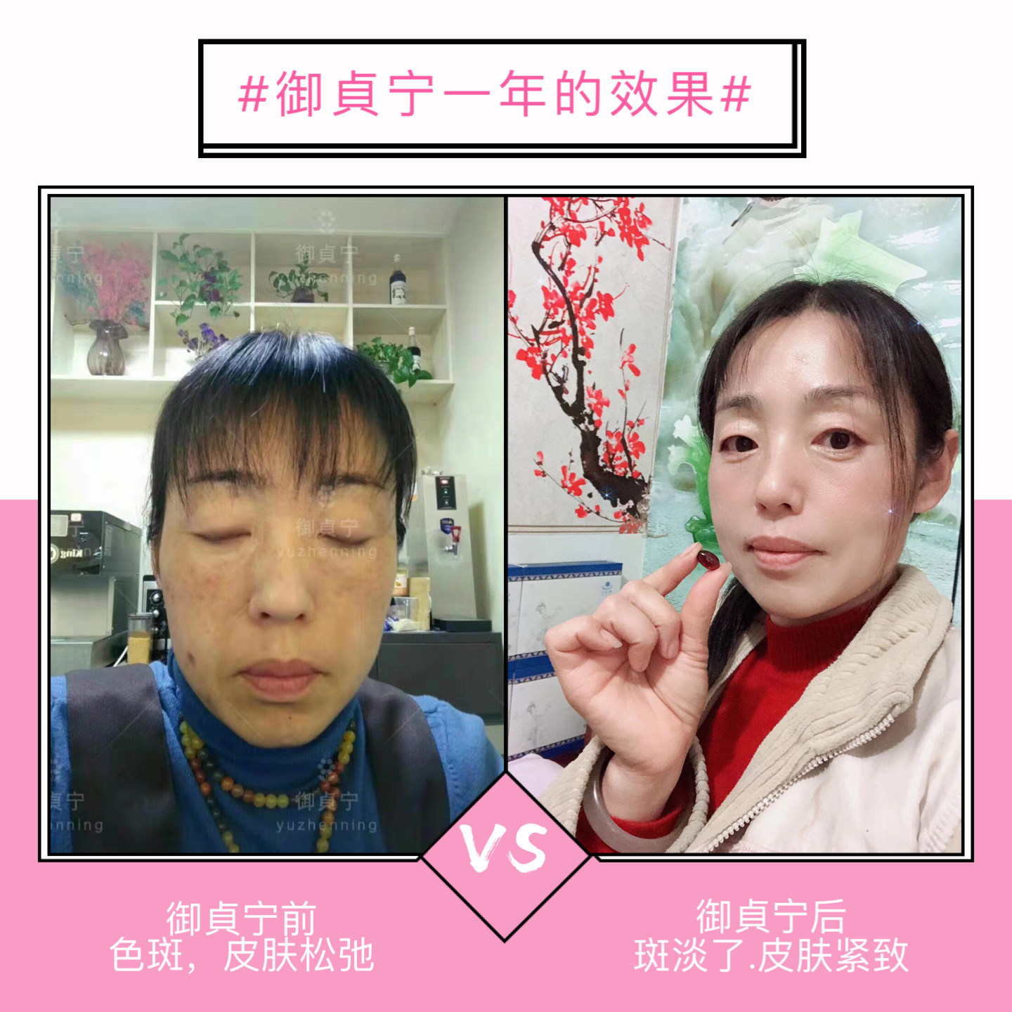 御貞宁美白淡斑一年的变化