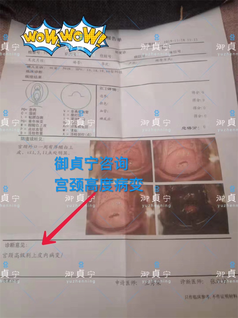 高级别上皮内瘤变康复、HPV16.18.58.66四项全部转阴
