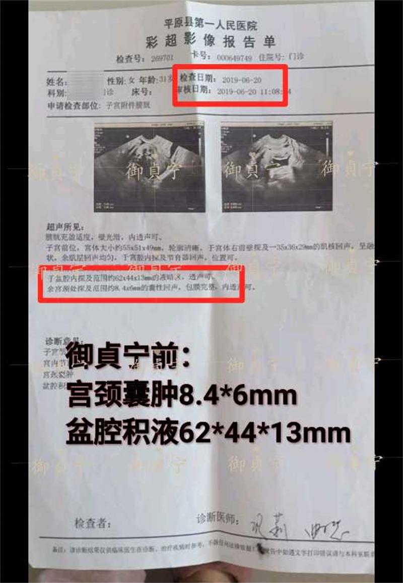 3盒御貞宁后:【宫颈囊肿缩小】