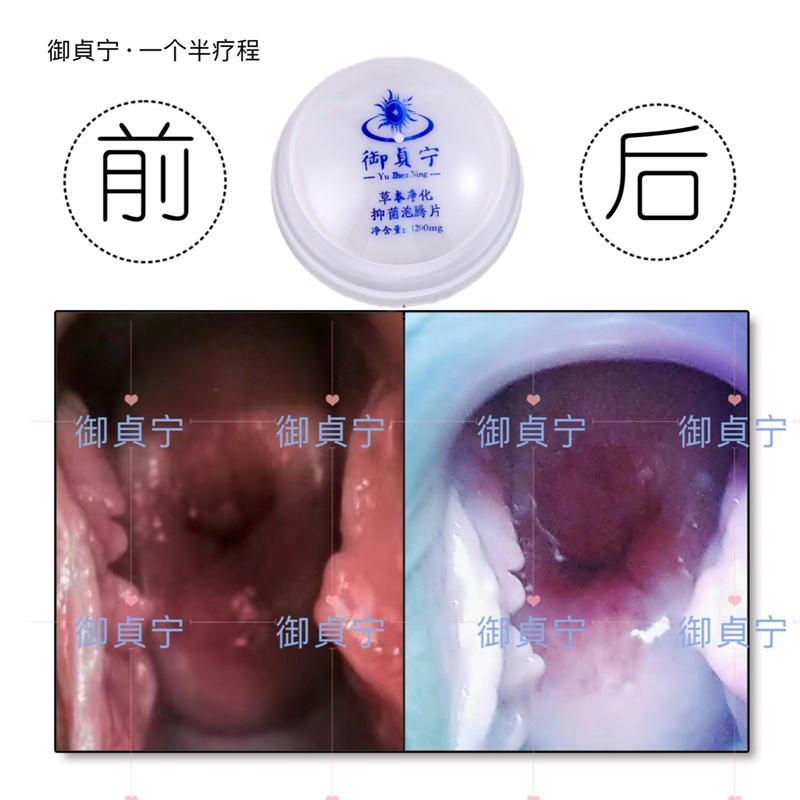 【调理宫颈的效果】御貞宁一个半疗程