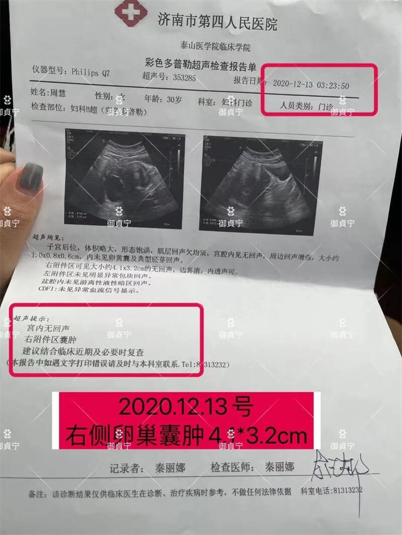 【卵巢囊肿 】4.1*3.8cm消失 孕期2个葫芦