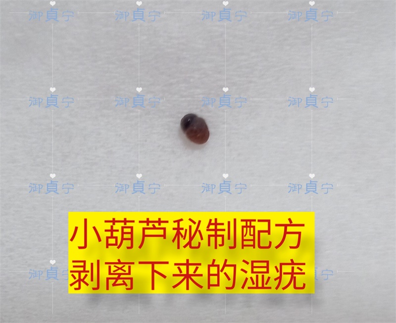 【尖锐湿疣·肛门疣体脱落】 用小葫芦不遭罪轻松剥离