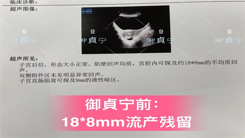 御貞宁排【流产残留】 ——18*8mm案例康复单据以及排出物