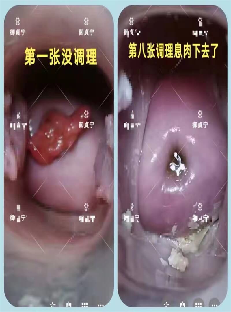一个疗程小葫芦后：【宫颈息肉】完全消失！宫颈肥大康复