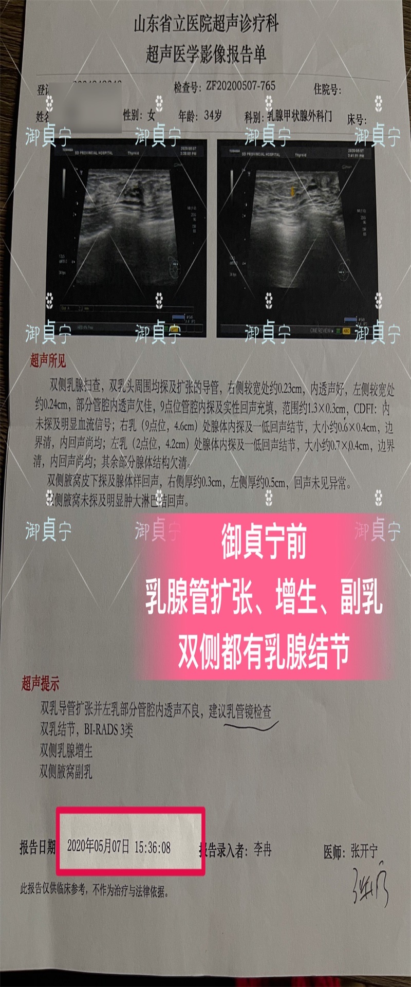 御貞宁前【 双乳乳腺管扩张增生结节 】后只剩左一个结节
