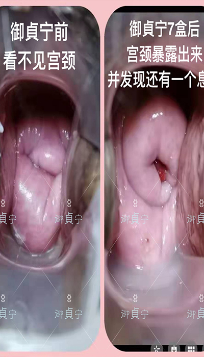 御貞宁7盒后宫颈暴露出来并且发现一个【息肉】
