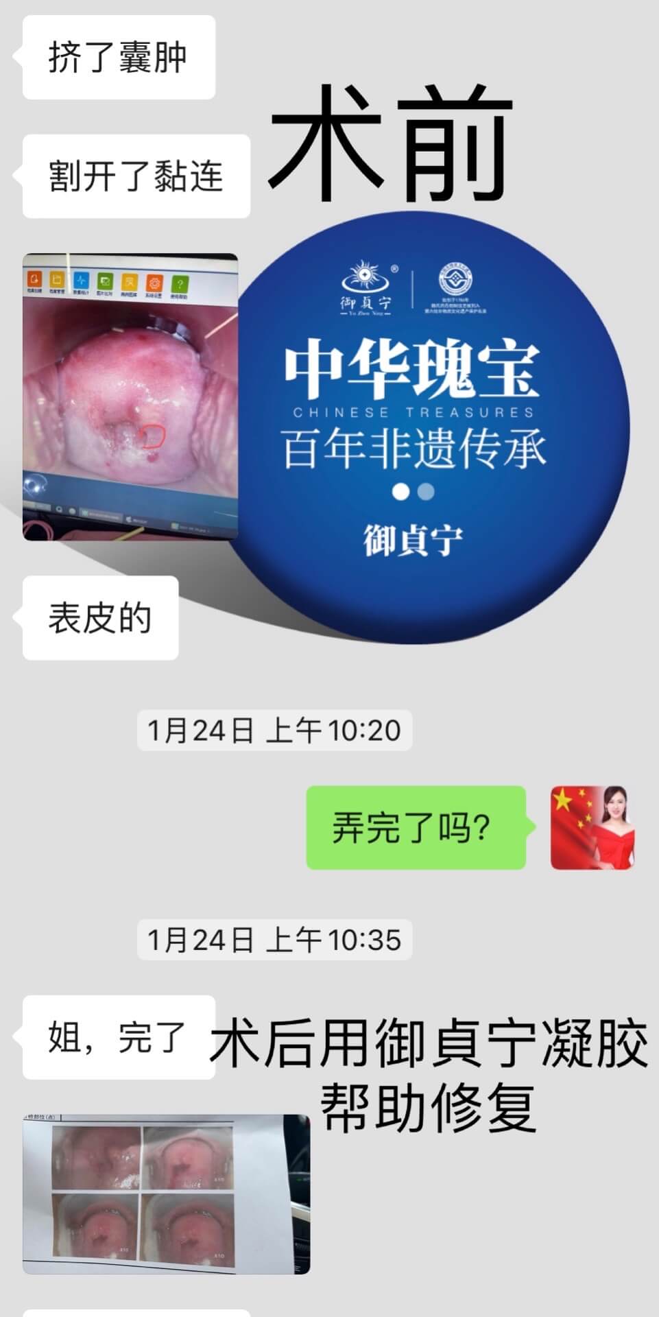 仅仅4支凝胶、宫颈光滑很多； 肉眼可见的康复修复速度。