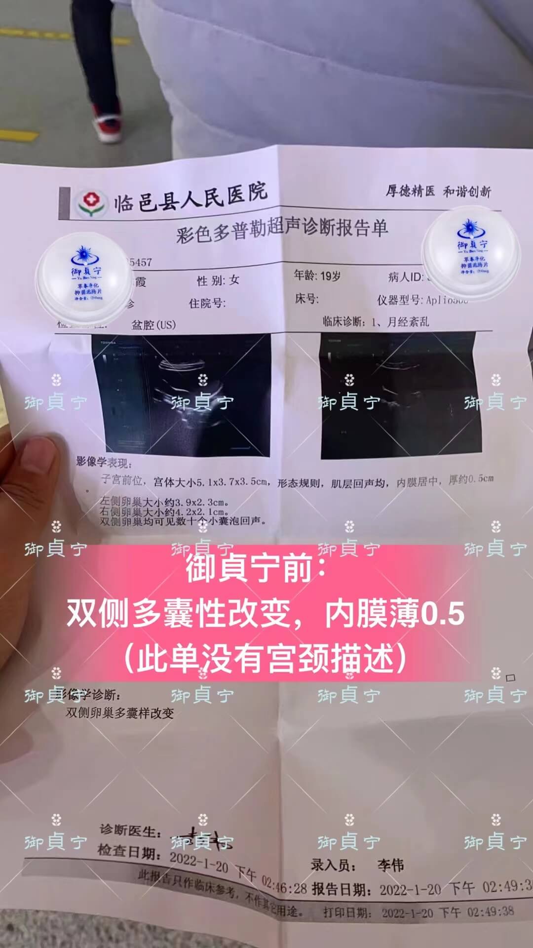 19岁，多囊卵巢康复 子宫内膜恢复正常